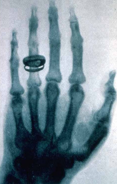 Jeden z prvních rentgen snimku 1896.JPG